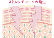 ストレッチマークの発生