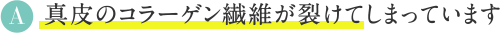 A 真皮のコラーゲン繊維が裂けてしまっています